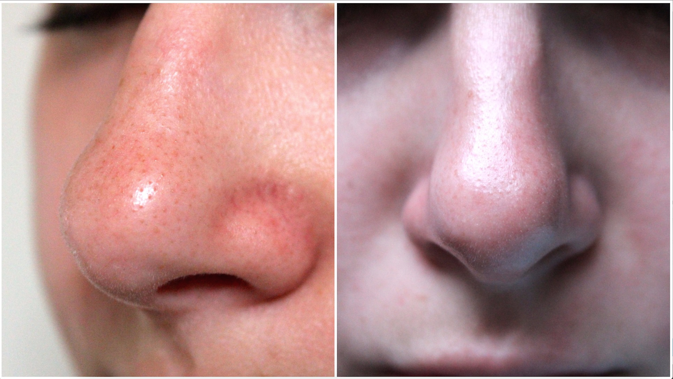 MyScheming_beforeafter_nose