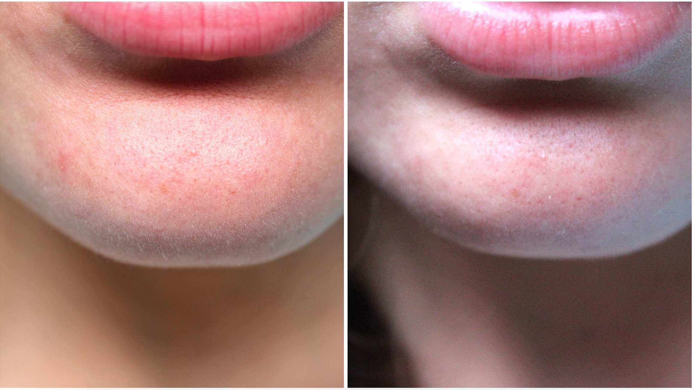 MyScheming_chin_beforeafter